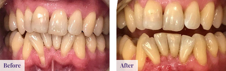 Connective Tissue Graft